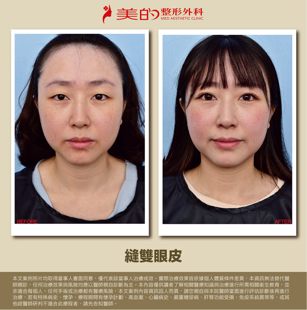 縫雙眼皮的術前術後比較