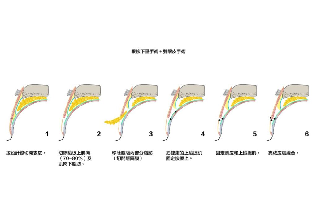 雙眼皮手術的操作方法