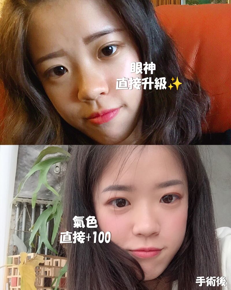 美的診所雙眼皮手術獨家案例