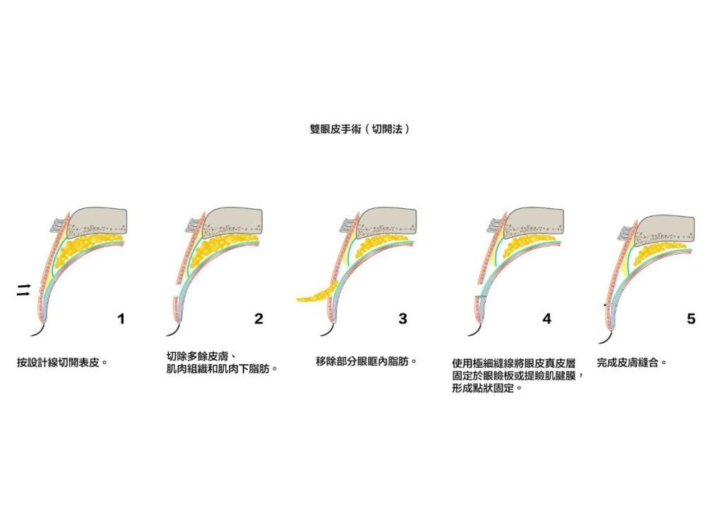 切開法的雙眼皮手術操作示意圖