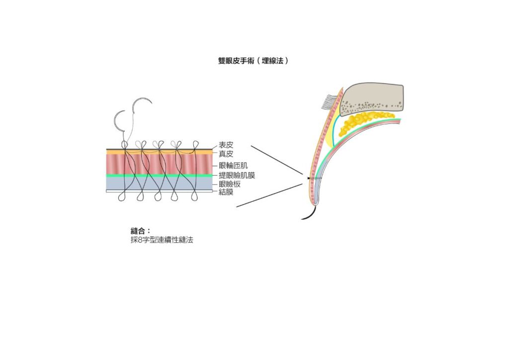 埋線法的雙眼皮手術操作方法