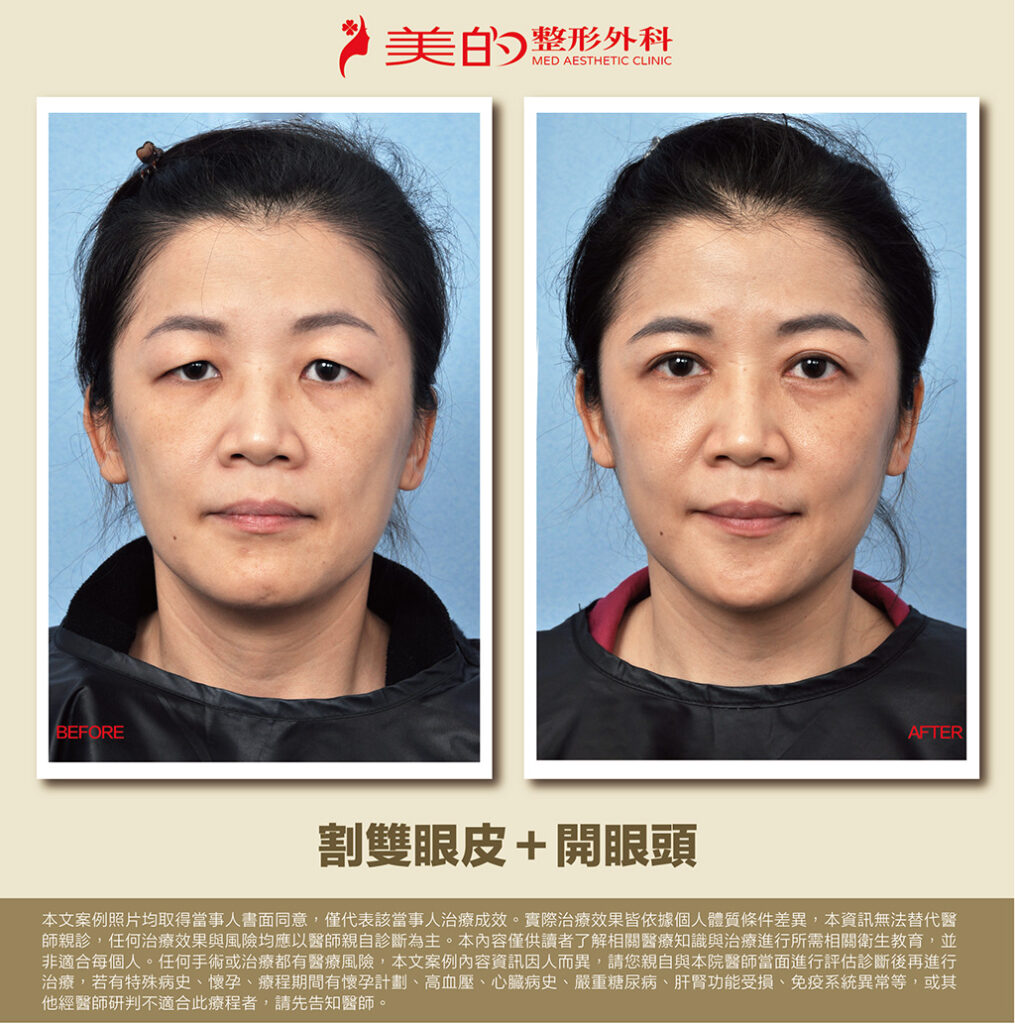 割雙眼皮手法大公開