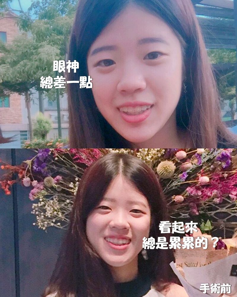 美的診所雙眼皮手術成果展現
